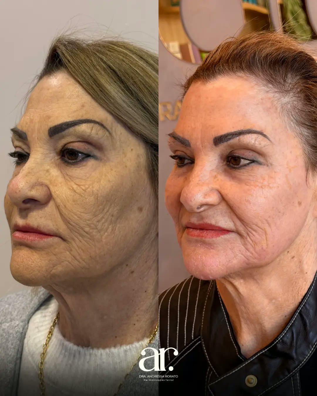Caso 1 da prática clínica da Dra. Andressa Rorato, antes e depois
